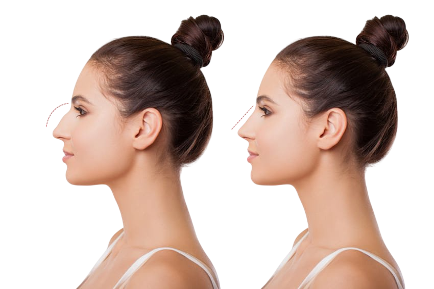 prix-chirurgie-nez-tunisie